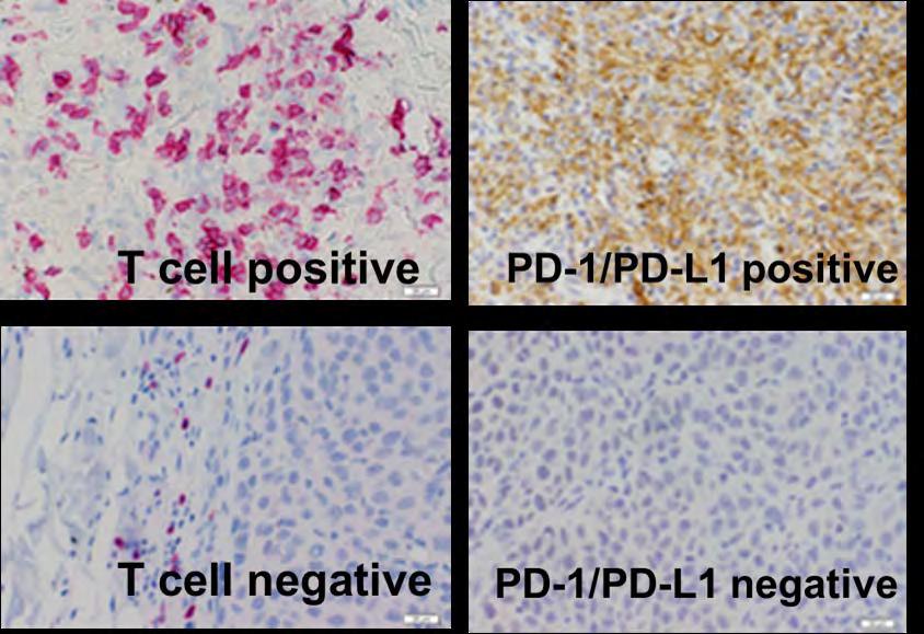 Inhibitory PD-1 receptors on T Cells block their response to tumors by engaging PD-1 ligand in the tumor Hot