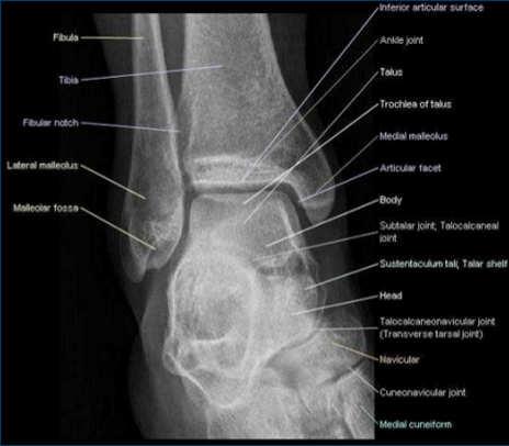 a b Patient is 10 yo Patient also has 5 th MT pain Ankle: Case #2 A 35 yo female has begun a walking program to get more fit and lose her 20# baby weight She lives with her family in a hilly part of