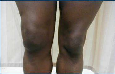 Which next question would be the least valuable in terms of determining the diagnosis? A. How long did it take before it swelled? B. Were you able to continue playing? 43% C. Does your knee give way?