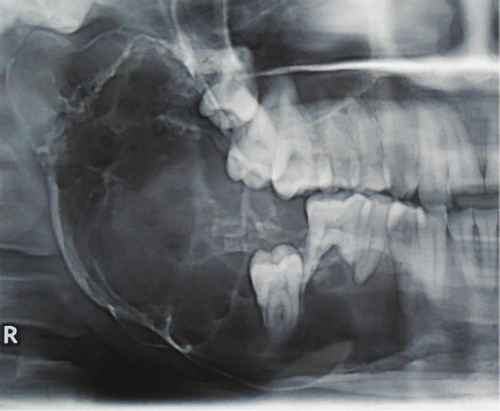 Extraorally swelling (Figure 1) was oval in shape, size 7 cm 6cm and extended anteriorly from the right corner of the oral cavity to posterior border of ramus of mandible.