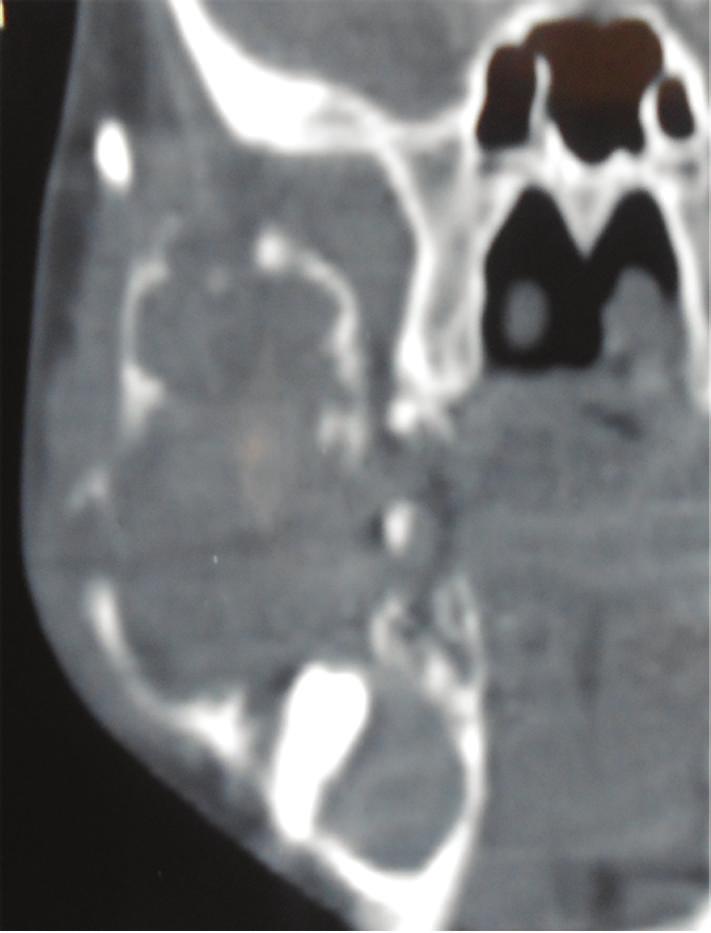 of patient with unilocular lesion is 26 years, whereas it is 38 years for multilocular ameloblastomas.