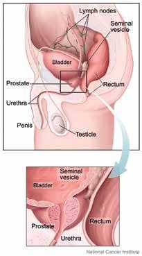 PROSTATE CANCER 101 WHAT IS PROSTATE CANCER? Prostate cancer is cancer that begins in the prostate.
