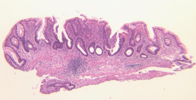 mucosal surface Plasma cells at base of mucosa + loss of plasma cell gradient Significance: Earliest feature of IBD Best predictor of IBD Other features (less discriminatory) Granulomas Mucin