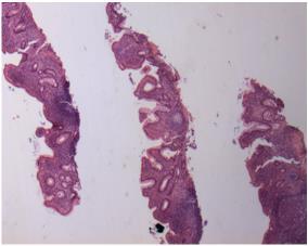 Architectural changes Chronic inflammation Distribution in biopsies Granulomas Where?