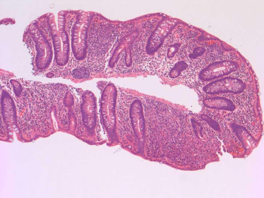 Crohn s disease > UC (initial biopsies) Typical Crohn s disease In any