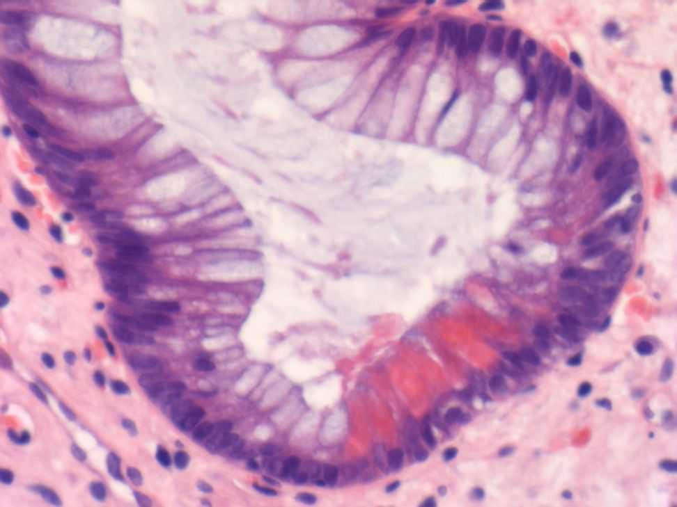 Cryptolytic granulomas also in UC and other colitides Paneth cells Not