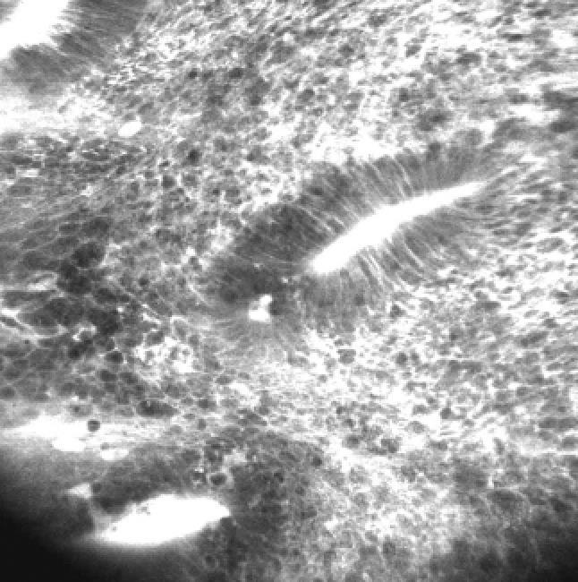 Confocal laser endomicroscopy Magnification x 1400 New techniques?
