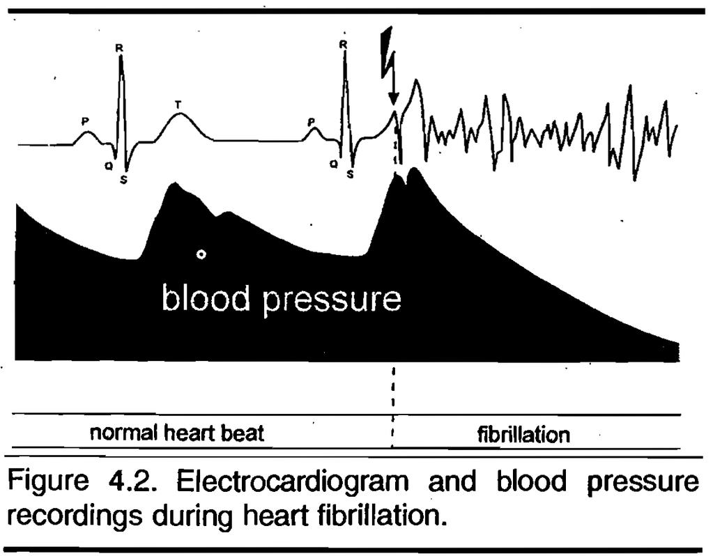 Ventricular fibrillation In cases of shock due to unwanted connection to power grid voltage, current passing through the heart is considered the most dangerous effect and can cause ventricular