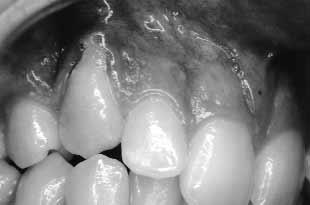 TREATMENT PLAN Fig 5. Pretreatment periapical radiograph of the upper right canine.