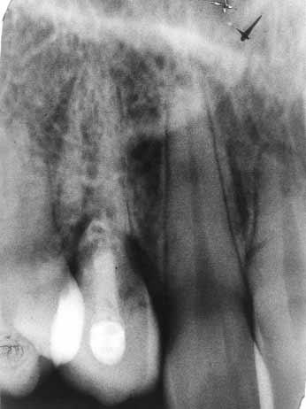 There was a question as to whether the upper left canine would also require full endodontic