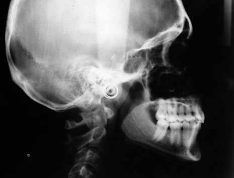 Examination of dental casts revealed a Bolton s discrepancy with excess tooth size in the lower incisor region.