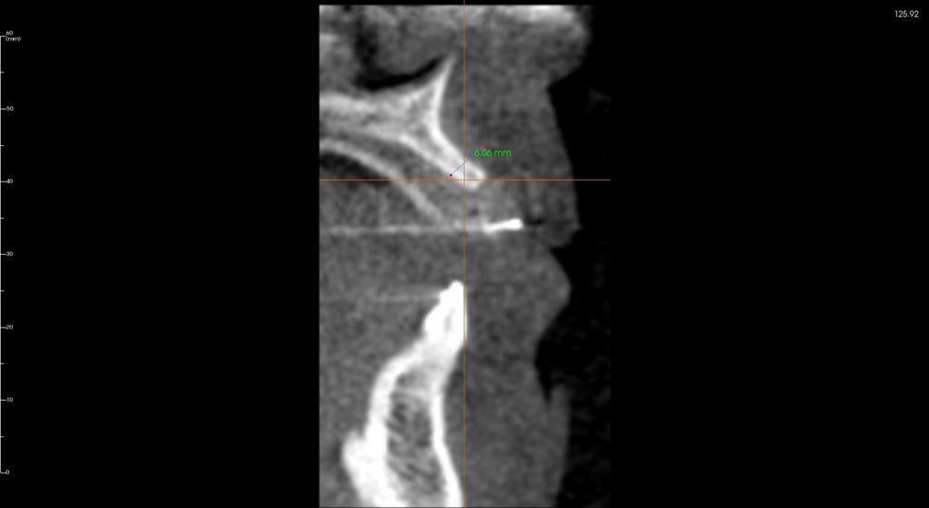 Bone Volume Deficiency Missing Upper lateral incisor 3D radiograph Cone beam CT scan to determine available bone volume Implant planning software to plan ideal implant