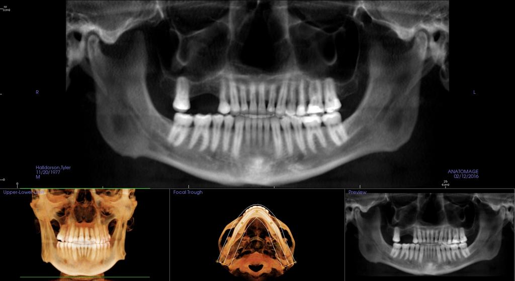 Implants and Maxillary Sinus Maxillary sinuses located at the apex of posterior teeth Implants should NEVER be inserted directly into the sinuses Bone grafting of