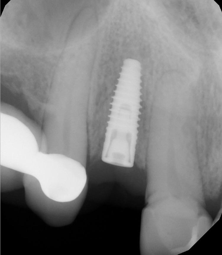 Two-Staged Implant Surgery When bone grafting is required, implant are