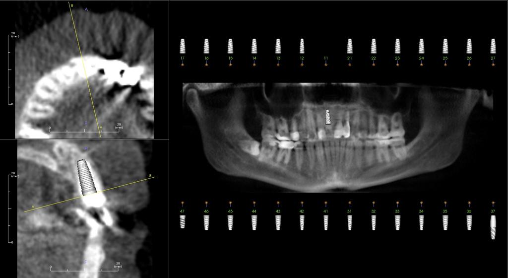 Immediate Implant Planning More complex surgical procedure Accuracy with angulation is crucial More predictable in single rooted tooth sockets Requires an