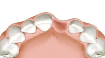 root leads to bone loss Bone resorbs where tooth is