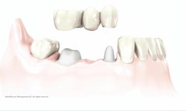 Options for Tooth Loss Replacement Replace the