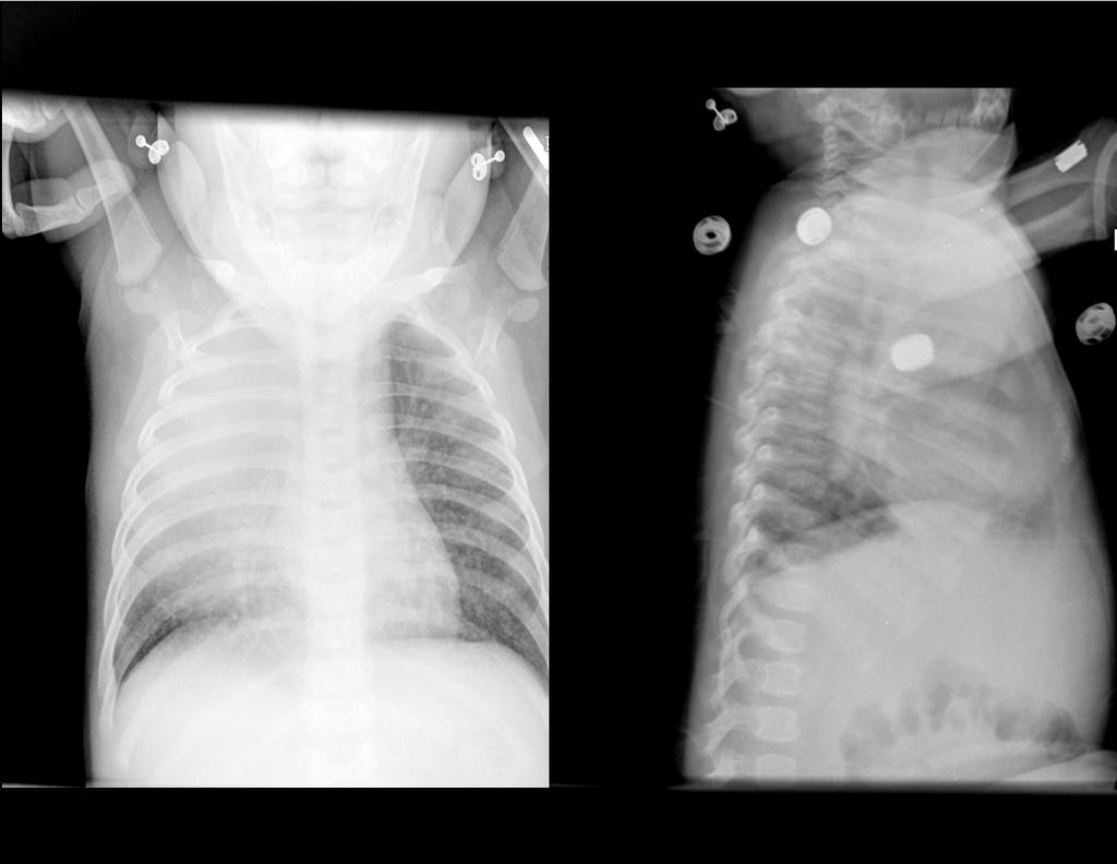 RADIOGRAPHIC FINDINGS IN PEDIATRIC TB DISEASE Typical of TB Hilar and interthoracic lymphadenopathy Miliary pattern Basilar enhancement