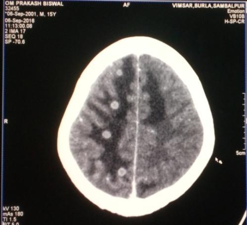 Figure 2:Distribution of different lesions on CT Lesions No of cases % TB 16 23 NCC 7 10 Brain abscess 4 6 Meningitis 5 7.