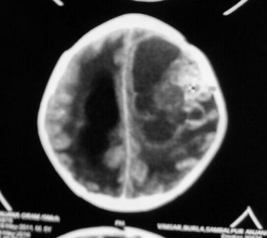 associated hydrocephalus with dilatation of temporal horns of lateral ventricle.