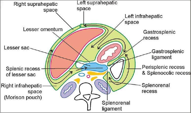 Supracolic compartment Peritoneal spaces: 1. Recessus subphrenicus dexter - bursa hepatica 2.