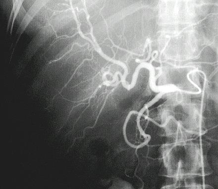Arteriogram of