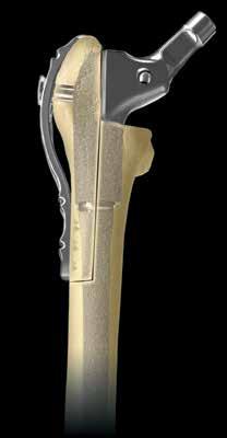 Broached Proximal Body Offset Option Standard and high offset options reproduce various patient anatomies without lengthening the leg Clinically Proven PPS Coating 1 4 Allows for initial scratch-fit