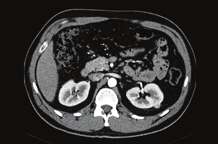 2 Case Reports in Medicine Figure 1: Contrast enhanced CT shows in the arterial phase a hypervascular small lesion in both kidneys, representing two small chromophobe renal cell carcinomas.