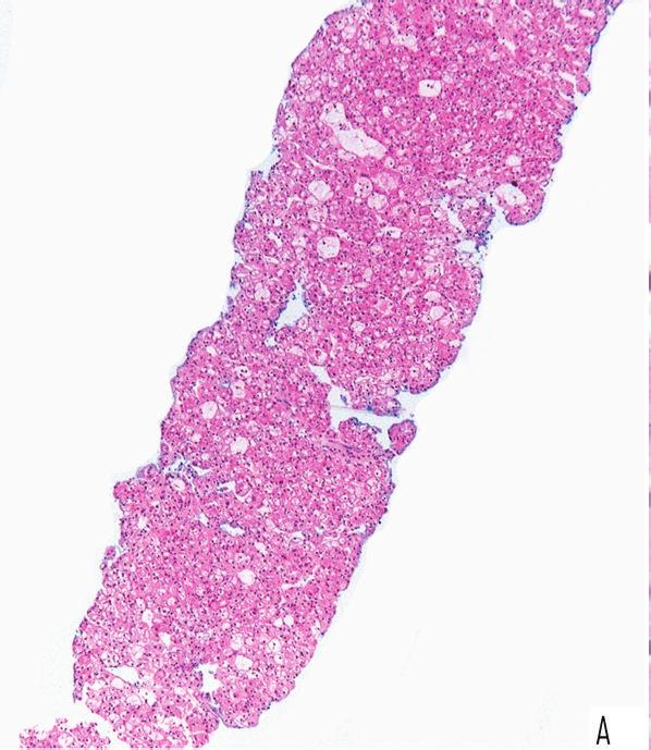 carcinoma. described before in literature and confirmed the diagnosis of Birt-Hogg-Dubé syndrome. The index patient had neither siblings nor children.
