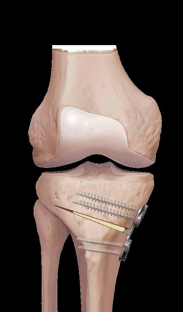 Tibial Opening