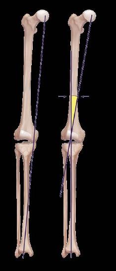 Tibial Opening Wedge
