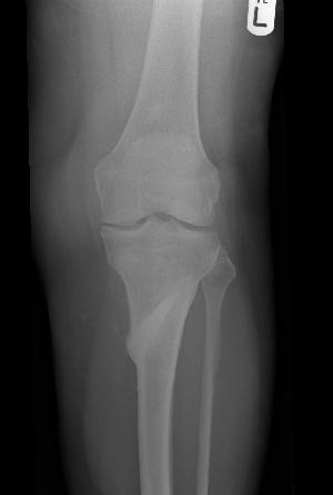 The Outcome of Bone Substitute Wedges in Medial Opening High Tibial Osteotomy The Open Orthopaedics Journal, 2013, Volume 7 375 RESULTS The primary indication for oblique medial HTO was medial