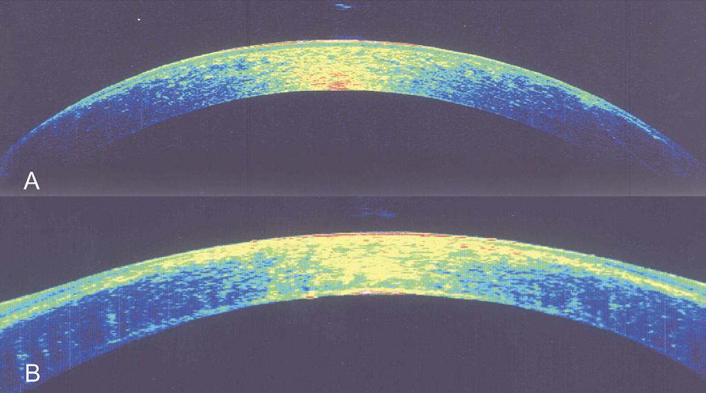 Ophthalmology Volume 120, Number 2, February 2013 Figure 5. Corneal optical coherence tomography images of patients after undergoing the (A) Anwar and (B) Melles techniques.