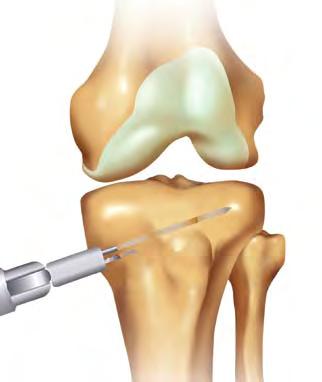 the femoral head to the center of the tibial-talar joint.