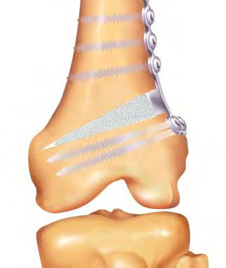 A final line is drawn from the center of the tibial-talar joint to the same point in