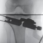 metal implants Allows microstrain transfer to