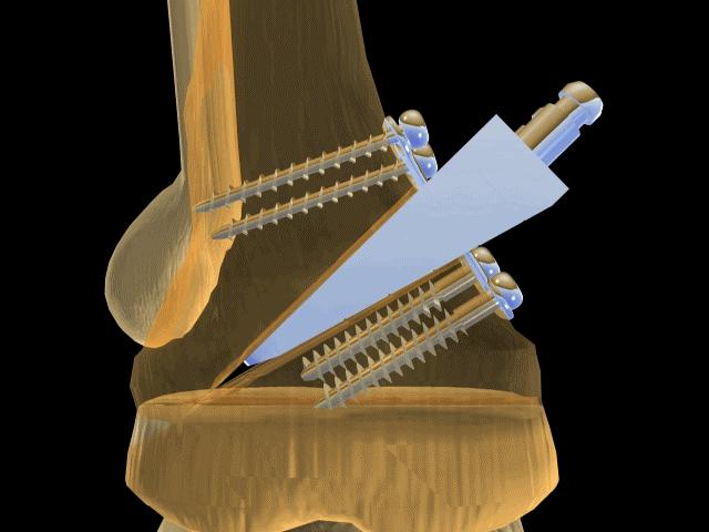 Arthrex Open Wedge Osteotomy Technique Designed in conjunction with: Dr. Giancarlo Puddu, M.D. Dr. Peter Fowler, M.