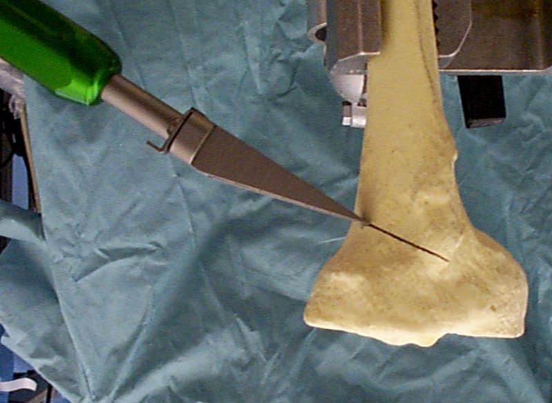 Inserting the Osteotomy Wedge The osteotomy wedge is assembled, inserted into the osteotomy, and driven to the mark equal to the desired width of the plate selected.