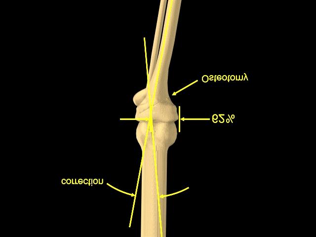 Angle of Correction A second line is drawn from that point to the center of the tibial-talor joint.