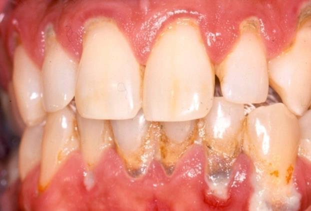Periodontal Disease Etiology: Chronic plaque at gum line Bacterial infection Host