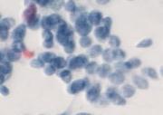 myxoid and chondroid Round hyaline balls Basaloid Oncocytic