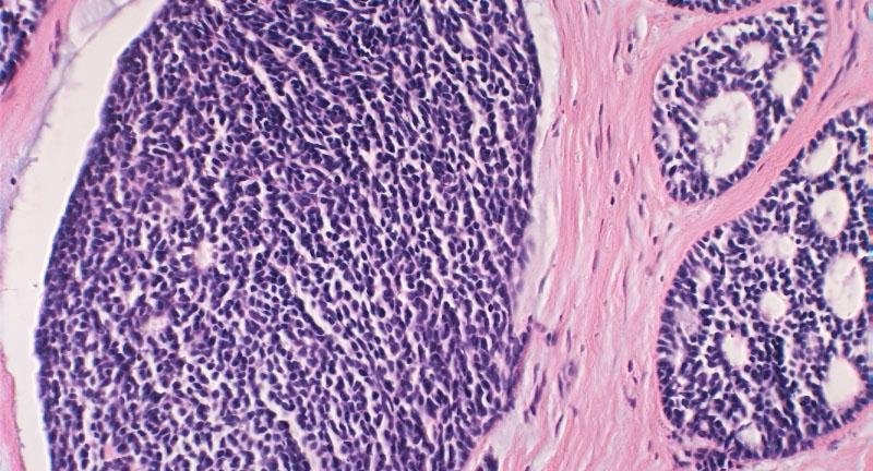 Solid (poorly differentiated) Adenoid Cystic Carcinoma Poorly differentiated tumors will show