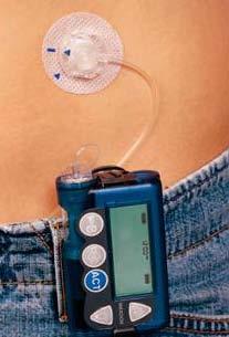 Insulin Pumps and the Insulin Used in the Pumps Covered for people with Medicare Part B who have diabetes and meet certain conditions Medicare covers the cost of insulin pumps and the insulin used in
