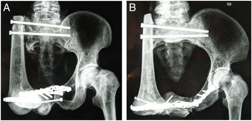 Mei et al. World Journal of Surgical Oncology 2014, 12:1 Page 3 of 6 Figure 2 Radiographs of the reconstructed pelvic ring. Hemipelvic defects were stabilized with a screw-plate system.