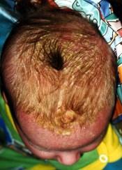 Seborrhea -red scaly eruption which often has a waxy