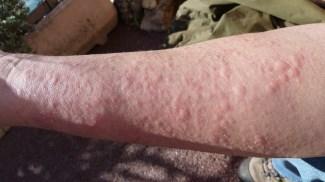 Urticaria -intensely pruritic -well-demarcated