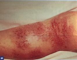 -red dry rough itchy papules/plaques that often
