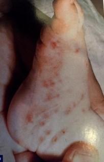 Scabies -highly contaigous infestation caused by a mite -eruption