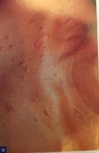 Pityriasis Rosea -benign, self-limited -herald patch followed by eruption of small
