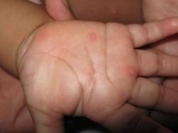 Hand Foot Mouth Fifth s Disease